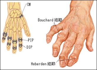 結節 完治 ヘバーデン