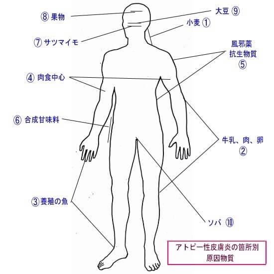 アトピー性皮膚炎