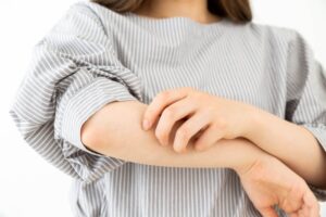 アトピー性皮膚炎にステロイド剤が効かない場合どうしますか？